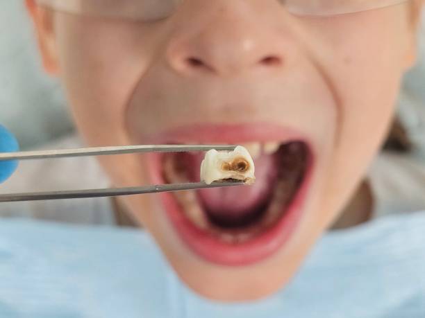 Best Emergency Dental Care for Sports Injuries in Gun Barrel City, TX